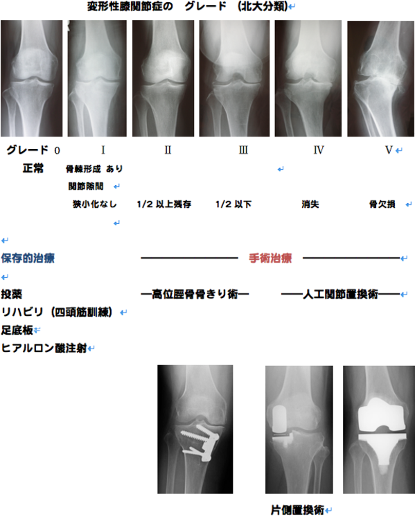 変形性ひざ関節症