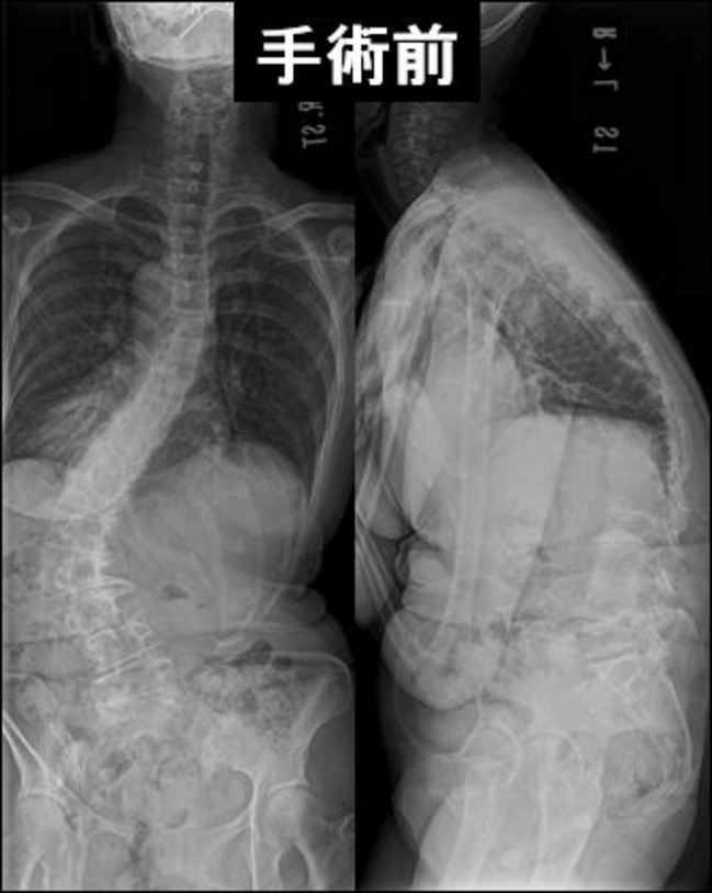 73歳脊椎 術前