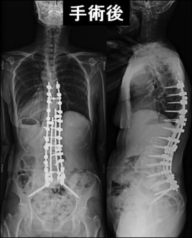 73歳脊椎 術後